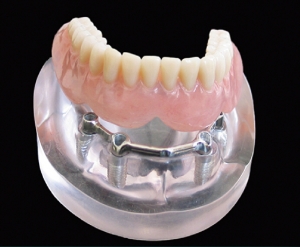 Overdenture on Implant Bar