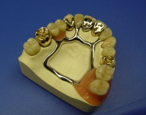 Gold Plated Metal Denture