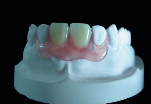 Valplast Denture