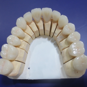 Full Arch Zirconia Crowns