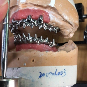 Implant Bar/Toronto Bridge framework