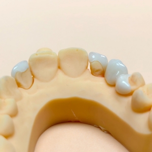 IPS Emax Veneer