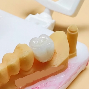 Zirconia Crown