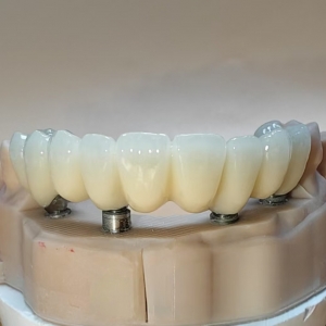 Composite Implant Bridge