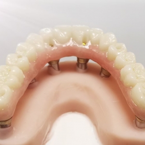Zirconia Implant